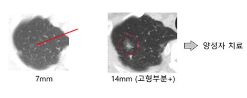 "폐암가능성 '폐 간유리 결절' 변화 없다가 10년 뒤부터도 자라"