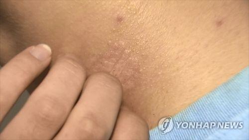 [위클리 건강] 삶의질 떨어뜨리는 은백색 각질 '건선'…"환자 30% 치료 포기"