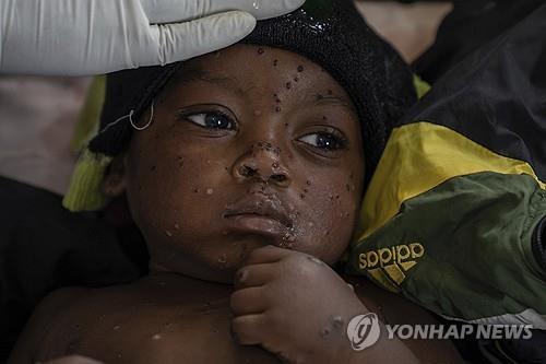 WHO "엠폭스, 여전히 국제공중보건 비상사태 해당"