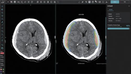 두개내출혈 검출 AI 설루션 'JLK-ICH', 미 FDA 승인 획득