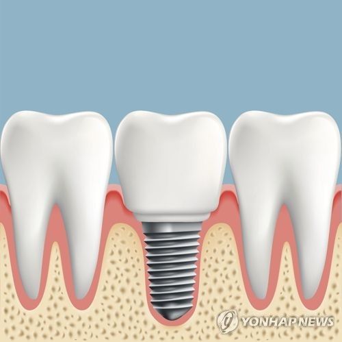 치과서 의료기기 업체 직원이 임플란트 시술 보조…벌금형