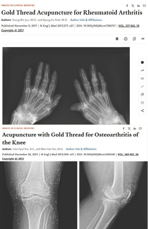 손과 무릎에서 금침이 발견된 사례가 ﻿의학학술지 ‘뉴잉글랜드 저널 오브 메디신(NEJM)에 실렸다. 양성관 의정부백병원 가정의학과 과장 페이스북