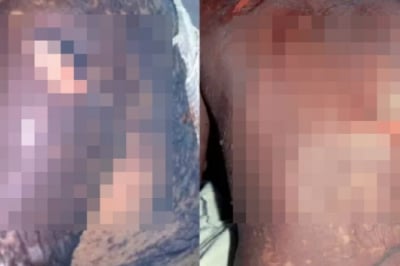 “공부 잘하는 약이래” 잘못 먹었다가… 치명적 피부 괴사