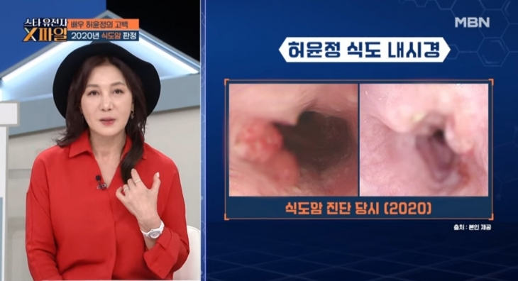 배우 허윤정이 5년 전 식도암 수술을 했다고 고백했다. MBN ‘임성훈의 스타 유전자 X파일’
