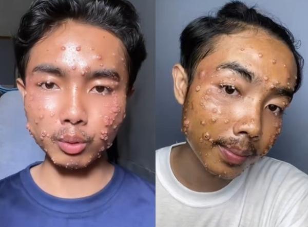 “얼굴에 혹이 울퉁불퉁”…피부 질환 생긴 男, ‘이 옷’ 입어서라는데
