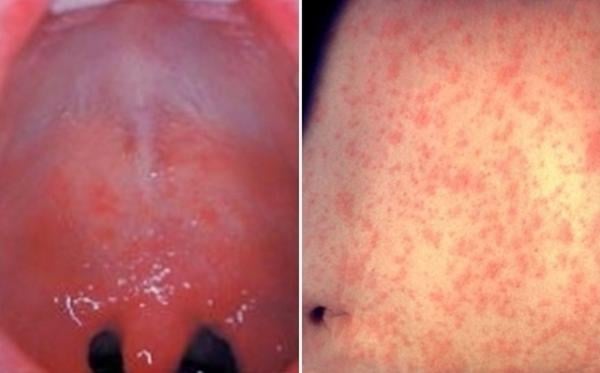 “해외 다녀온 뒤 몸이 이상”…90% 전염 ‘홍역’ 번지고 있다
