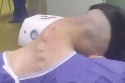 “목이 흐늘흐늘 늘어지다 90도 ‘푹’ 꺾여”…의료진 경악한 ‘마약’의 충격 부작용