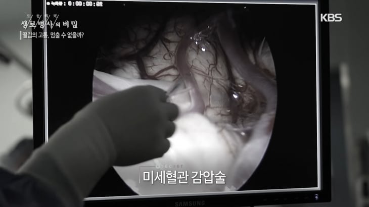 ‘미세혈관 감압술’을 시행하는 모습. KBS ‘생로병사의 비밀’ 방송화면