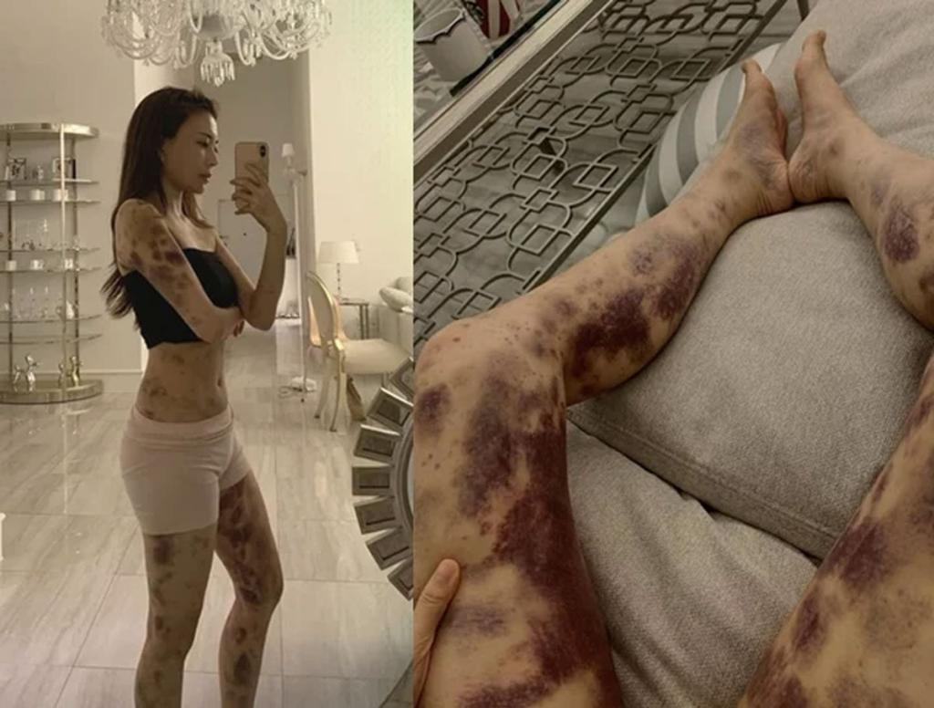 아옳이, 13억 명예훼손 소송서 최종 승소…“전신 피멍 사진, 허위 아니었다”