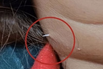 생선 가시 삼켰다가 목 뚫고 나와…“‘이 행동’ 하지 마세요” 사망까지