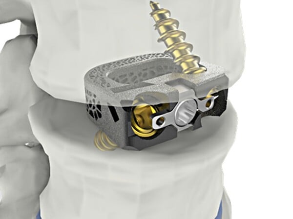시지메드텍, 척추 임플란트 ‘유니스페이스’ FDA 승인